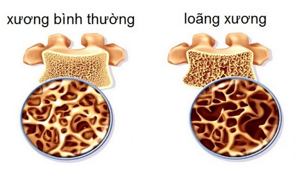 Bài thuốc hỗ trợ trị loãng xương 1