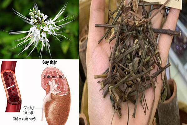 Bệnh thận và sỏi thận 1 Bệnh thận và sỏi thận 1