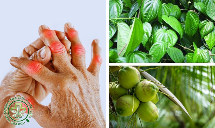 2.4. Chữa bệnh gút bằng lá trầu không và nước dừa 1 2.4. Chữa bệnh gút bằng lá trầu không và nước dừa 1