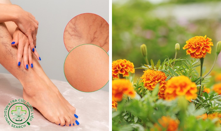 3. Chữa suy giãn tĩnh mạch bằng cúc vạn thọ 1 3. Chữa suy giãn tĩnh mạch bằng cúc vạn thọ 1