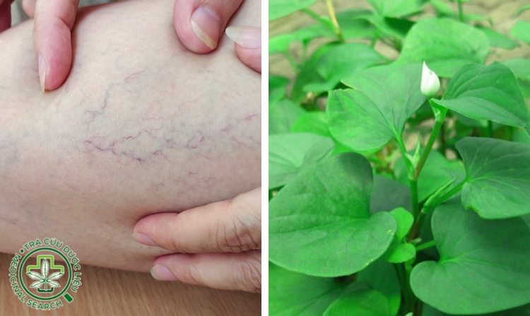 4. Chữa suy giãn tĩnh mạch bằng diếp cá 1 4. Chữa suy giãn tĩnh mạch bằng diếp cá 1