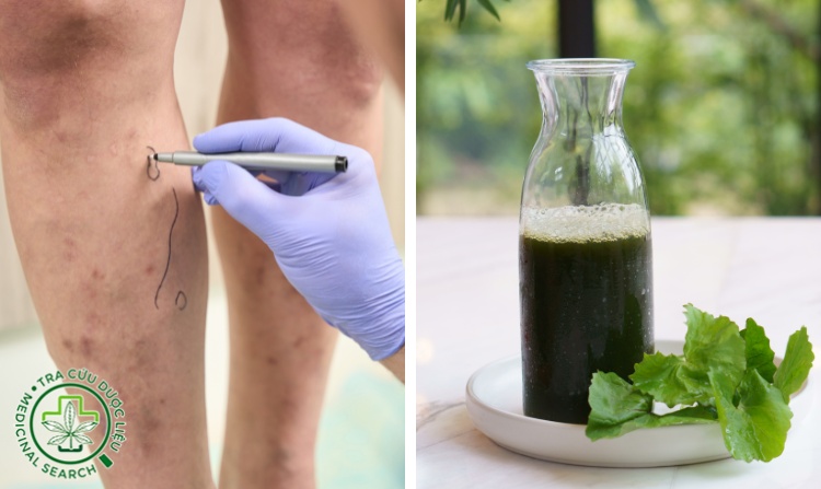 2. Chữa suy giãn tĩnh mạch bằng rau má 1 2. Chữa suy giãn tĩnh mạch bằng rau má 1