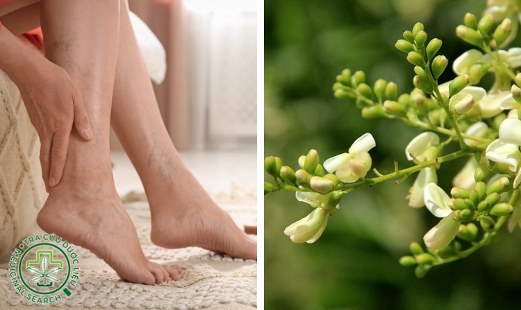 1. Chữa suy giãn tĩnh mạch bằng hoa hoè 1 1. Chữa suy giãn tĩnh mạch bằng hoa hoè 1