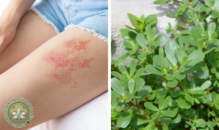 2.3. Chữa zona thần kinh bằng rau sam 1 2.3. Chữa zona thần kinh bằng rau sam 1