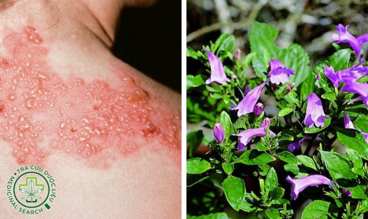 2.7. Chữa zona thần kinh bằng cây thanh đại 1 2.7. Chữa zona thần kinh bằng cây thanh đại 1