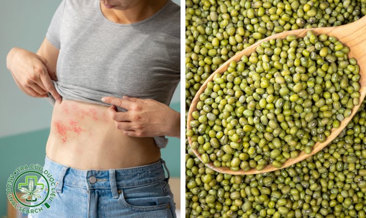 2.1. Chữa zona thần kinh bằng đậu xanh 1 2.1. Chữa zona thần kinh bằng đậu xanh 1