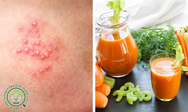 2.5. Chữa zona thần kinh bằng cà rốt và cần tây 1 2.5. Chữa zona thần kinh bằng cà rốt và cần tây 1