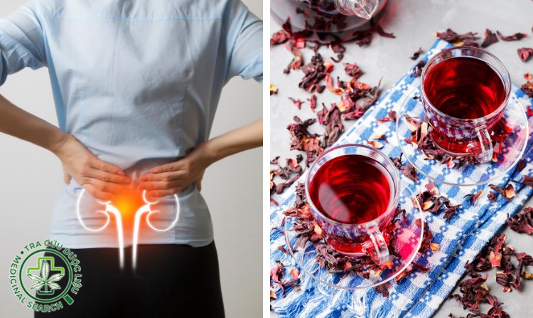 5. Cải thiện bệnh sỏi thận bằng cây bụp giấm 1 5. Cải thiện bệnh sỏi thận bằng cây bụp giấm 1