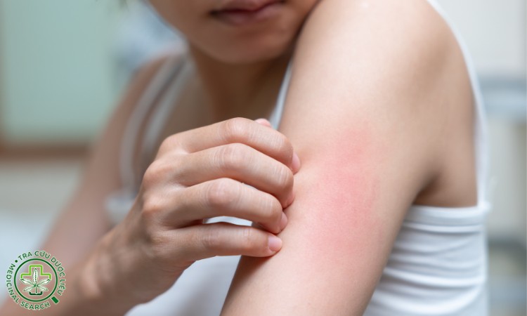 Biểu hiện dị ứng sữa ong chúa 1