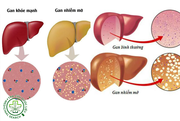 Tìm hiểu nhanh về gan nhiễm mỡ 1